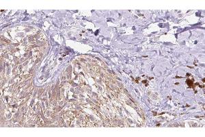 ABIN6279754 at 1/100 staining Human Melanoma tissue by IHC-P. (Reelin anticorps  (N-Term))