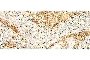 Immunohistochemistry of paraffin-embedded Human esophagus cancer tissue using EEF1AKMT2 Polyclonal Antibody at dilution of 1:50(x200) (METTL10 anticorps)