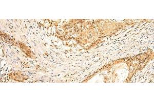 Immunohistochemistry of paraffin-embedded Human esophagus cancer tissue using EEF1AKMT2 Polyclonal Antibody at dilution of 1:50(x200)