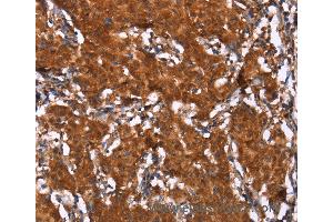 Immunohistochemistry of Human thyroid cancer using HCAR2 Polyclonal Antibody at dilution of 1:40 (HCAR2 anticorps)