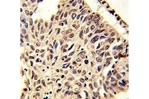IHC analysis of FFPE human lung carcinoma stained with H4 antibody (HIST1H4A anticorps  (meLys20))