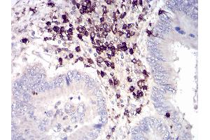 Immunohistochemical analysis of paraffin-embedded rectum cancer tissues using rectum cancer mouse mAb with DAB staining.