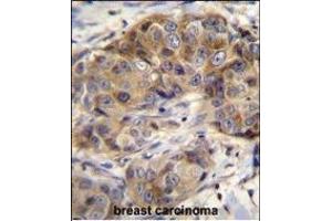 GSR Antibody (C-term) (ABIN655985 and ABIN2845369) immunohistochemistry analysis in formalin fixed and paraffin embedded human breast carcinoma followed by peroxidase conjugation of the secondary antibody and DAB staining.