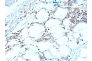 Formalin-fixed, paraffin-embedded human Mesothelioma stained with Calretinin Mouse Monoclonal Antibody (CALB2/2603). (Calretinin anticorps  (AA 23-242))