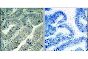 Immunohistochemistry analysis of paraffin-embedded human colon carcinoma, using Src (Phospho-Tyr418) Antibody.