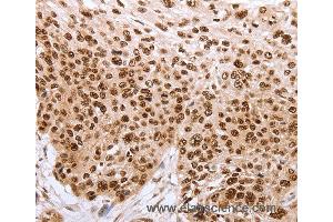 Immunohistochemistry of Human esophagus cancer using PARP1 Polyclonal Antibody at dilution of 1:40 (PARP1 anticorps)