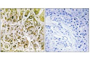 Immunohistochemistry analysis of paraffin-embedded human breast carcinoma tissue, using Smad1 (Phospho-Ser187) antibody.