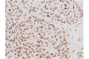 ABIN6267601 at 1/200 staining Human liver cancer tissue sections by IHC-P.