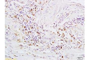 Formalin-fixed and paraffin embedded human rectal carcinoma tissue labeled with Rabbit Anti-GPR30 Polyclonal Antibody  at 1:200 followed by conjugation to the secondary antibody and DAB staining.