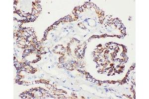 IHC-P: Peroxiredoxin 5 antibody testing of human prostatic cancer tissue (Peroxiredoxin 5 anticorps  (C-Term))