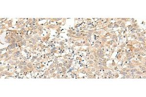 Immunohistochemistry of paraffin-embedded Human cervical cancer tissue using FUT3 Polyclonal Antibody at dilution of 1:35(x200) (FUT3 anticorps)