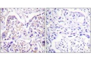 Immunohistochemistry analysis of paraffin-embedded human breast carcinoma tissue, using IRS-1 (Ab-323) Antibody. (IRS1 anticorps  (AA 289-338))