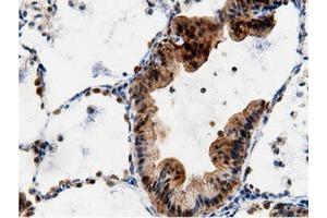Immunohistochemical staining of paraffin-embedded Adenocarcinoma of Human breast tissue using anti-AK5 mouse monoclonal antibody. (Adenylate Kinase 5 anticorps)