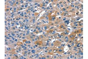 The image on the left is immunohistochemistry of paraffin-embedded Human liver cancer tissue using ABIN7130906(RNF7 Antibody) at dilution 1/20, on the right is treated with fusion protein. (RNF7 anticorps)