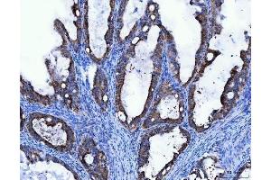 IHC analysis of TRK fused gene/TFG using anti-TRK fused gene/TFG antibody (ABIN7599839). (TFG anticorps  (AA 121-400))