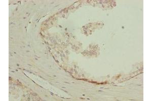 Immunohistochemistry of paraffin-embedded human prostate cancer using ABIN7158732 at dilution of 1:100