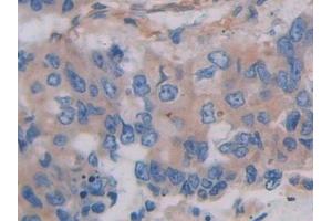Detection of FLNC in Human Breast cancer Tissue using Polyclonal Antibody to Filamin C Gamma (FLNC)