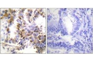 Immunohistochemistry analysis of paraffin-embedded human lung carcinoma tissue, using 4E-BP1 (Ab-36) Antibody. (eIF4EBP1 anticorps  (AA 2-51))
