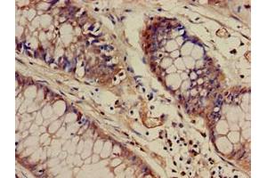 Immunohistochemistry of paraffin-embedded human colon cancer using ABIN7175830 at dilution of 1:100