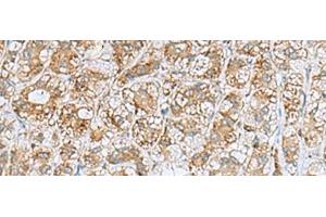Immunohistochemistry of paraffin-embedded Human liver cancer tissue using NQO2 Polyclonal Antibody at dilution of 1:70(x200)