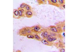 Immunohistochemical analysis of BCKDK staining in human liver cancer formalin fixed paraffin embedded tissue section.