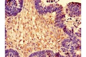 Immunohistochemistry of paraffin-embedded human ovarian cancer using ABIN7142792 at dilution of 1:100 (RPL28 anticorps  (AA 2-137))