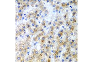 Immunohistochemistry of paraffin-embedded human liver cancer using LY86 antibody. (LY86 anticorps)