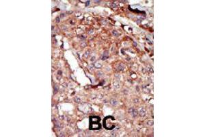 Formalin-fixed and paraffin-embedded human cancer tissue reacted with BRD2 polyclonal antibody  , which was peroxidase-conjugated to the secondary antibody, followed by AEC staining. (BRD2 anticorps  (Internal Region))