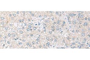 Immunohistochemistry of paraffin-embedded Human liver cancer tissue using FARP2 Polyclonal Antibody at dilution of 1:70(x200)