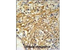 DC13 Antibody (N-term) (ABIN651108 and ABIN2840074) IHC analysis in formalin fixed and paraffin embedded human breast carcinoma followed by peroxidase conjugation of the secondary antibody and DAB staining.