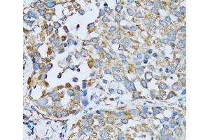 Immunohistochemistry of paraffin-embedded Human lung cancer using RARS Polyclonal Antibody at dilution of 1:100 (40x lens).