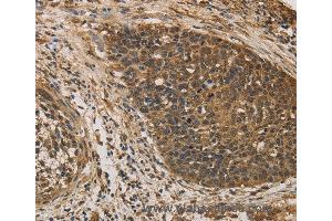 Immunohistochemistry of Human colon cancer using DACH1 Polyclonal Antibody at dilution of 1:50 (DACH1 anticorps)