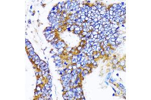 Immunohistochemistry of paraffin-embedded human colon carcinoma using MRPL13 antibody  at dilution of 1:100 (40x lens). (MRPL13 anticorps  (AA 1-179))