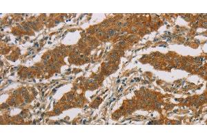 Immunohistochemistry of paraffin-embedded Human gasrtic cancer tissue using CYP39A1 Polyclonal Antibody at dilution 1:50 (CYP39A1 anticorps)