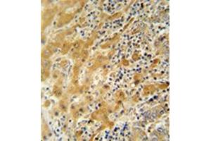 Immunohistochemistry analysis in formalin fixed and paraffin embedded human hepatocarcinoma reacted with NUSAP1 / ANKT Antibody (N-term) followed by peroxidase conjugation of the secondary antibody and DAB staining. (NUSAP1 anticorps  (N-Term))