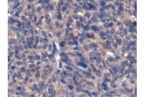 Detection of AFP in Human Ovarian cancer Tissue using Monoclonal Antibody to Alpha-Fetoprotein (AFP)