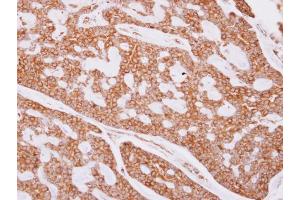 IHC-P Image beta Tubulin antibody detects beta Tubulin protein at cytoplasm on human breast cancer by immunohistochemical analysis.