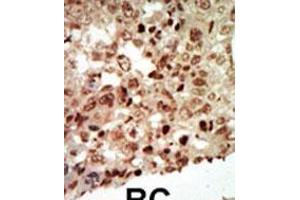 Formalin-fixed and paraffin-embedded human cancer tissue reacted with the primary antibody, which was peroxidase-conjugated to the secondary antibody, followed by AEC staining. (MAPK11 anticorps  (AA 334-366))