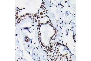 Immunohistochemistry of paraffin-embedded human breast cancer using HDGF Rabbit pAb  at dilution of 1:50 (40x lens). (HDGF anticorps  (AA 1-240))