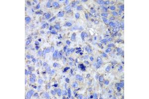 Immunohistochemistry of paraffin-embedded human lung cancer using CASP7 antibody (ABIN5970716) at dilution of 1/100 (40x lens). (Caspase 7 anticorps)