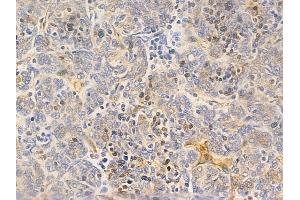 ABIN6265724 and ABIN6266700 at 1/100 staining human thymoma by IHC-P. (MID1 anticorps  (N-Term))