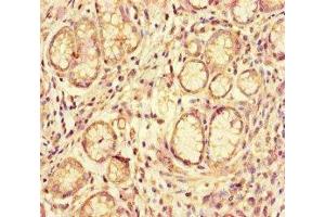 Immunohistochemistry of paraffin-embedded human gastric cancer using ABIN7144126 at dilution of 1:100 (ACE2 anticorps  (AA 395-638))