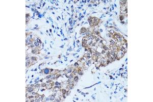 Immunohistochemistry of paraffin-embedded human lung cancer using CASP3 antibody (ABIN5997372) at dilution of 1/100 (40x lens). (Caspase 3 anticorps)