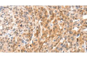 Immunohistochemistry of paraffin-embedded Human esophagus cancer using ANXA8 Polyclonal Antibody at dilution of 1:35 (Annexin VIII anticorps)