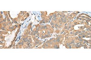 Immunohistochemistry of paraffin-embedded Human thyroid cancer tissue using CA6 Polyclonal Antibody at dilution of 1:35(x200) (CA6 anticorps)