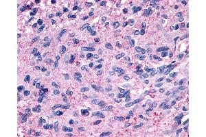 Anti-GPR139 antibody IHC of human Brain, Glioblastoma.