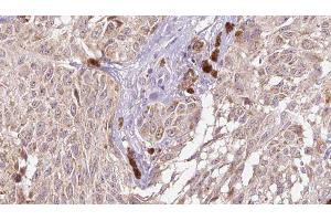 ABIN6274983 at 1/100 staining Human Melanoma tissue by IHC-P.