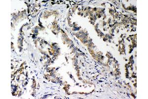 Anti-PLK2 antibody, IHC(P) IHC(P): Human Lung Cancer Tissue (PLK2 anticorps  (C-Term))