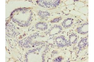 Immunohistochemistry of paraffin-embedded human breast cancer using ABIN7174434 at dilution of 1:100