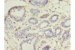 Immunohistochemistry of paraffin-embedded human breast cancer using ABIN7174434 at dilution of 1:100 (UBE2D1 anticorps  (AA 1-147))
